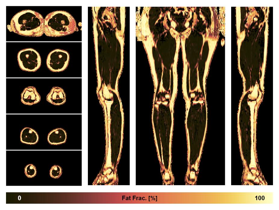 The fat fraction of the lower extremity obtained from the dixon reconstruction for muscle water fat quantification.